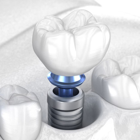 Implant Dentistry by Dr. Tyler Hicks