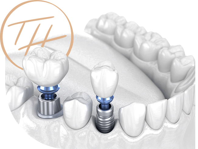 implants-img-1-b Dental Implants 3D Model