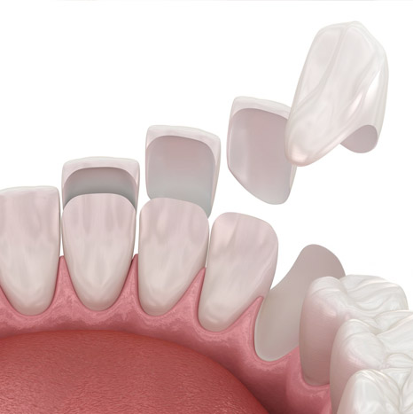 Veneers by Dr. Tyler Hicks in Scottsdale, AZ.