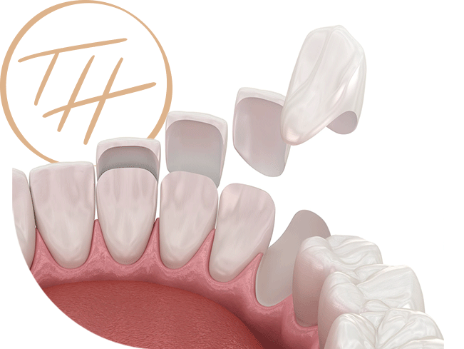 veneers-img-1 Minimal-Prep and No-Prep Veneers by Dr. Tyler Hicks in Scottsdale, Arizona.